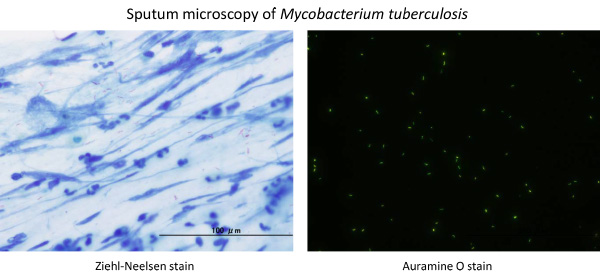 Sputum microscopy of Mycrobacterium tuberculosis