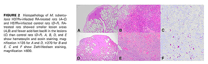 figure 2 Histopathology of M. tuberculosis H37Rv-infected RA-treated rats(A-C) and H37Rv-infected control rats(D-F)
